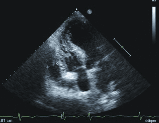 L'échocardiographie en réanimation cardiaque