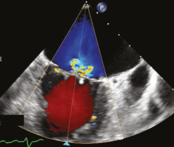 KEPHALIOS annonce une première implantation de Kalios, son dispositif  innovant de réparation de la valve mitrale