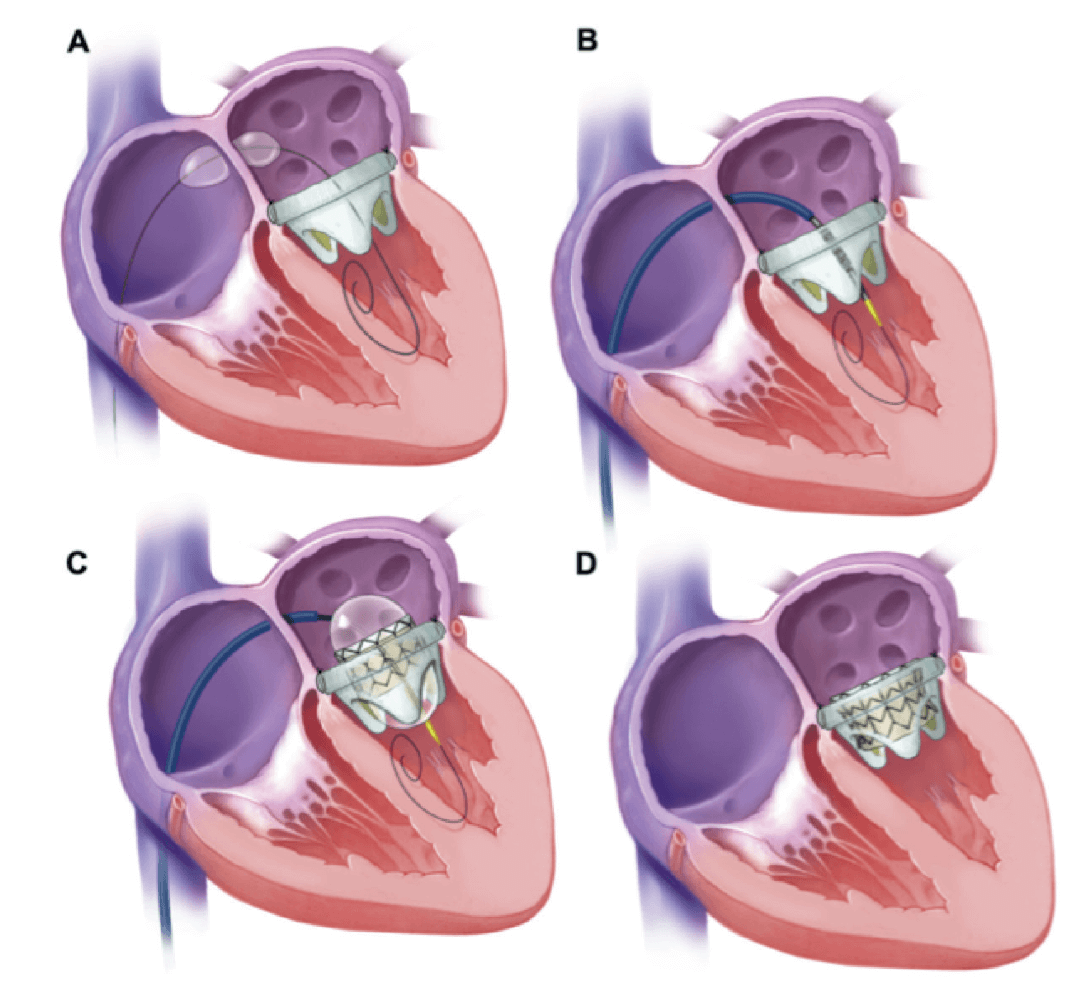 Chirurgie de la valve tricuspide  Unité de cardiologie et de chirurgie  cardiaque Jacques Cartier