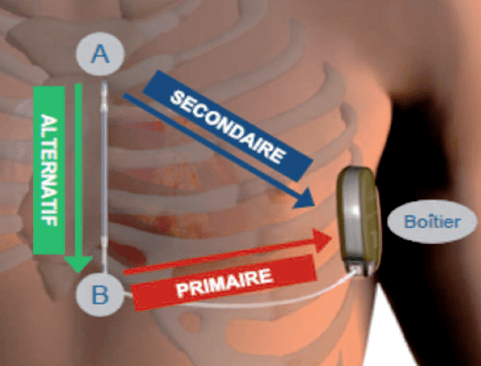 Défibrillateur automatique implantable – Institut de cardiologie