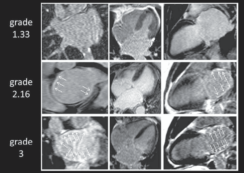 Fibrose de l'oreillette gauche à l'IRM et ablation de FA persistante ...