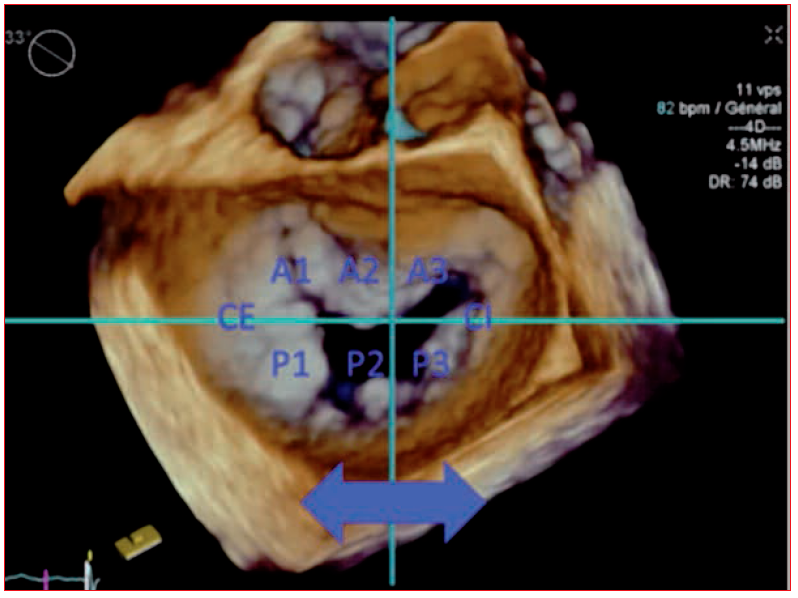 Cardiologie : avancées génétiques majeures dans la compréhension du  prolapsus de la valve mitrale
