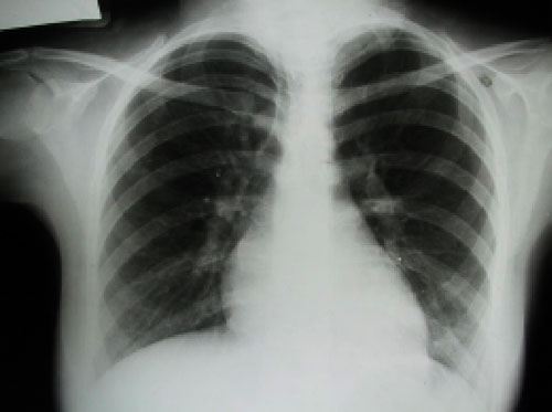 Embolie pulmonaire massive : que faire en cas d'échec de la ...
