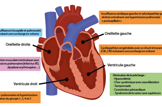 Hypertension pulmonaire – Institut de cardiologie de l'Université