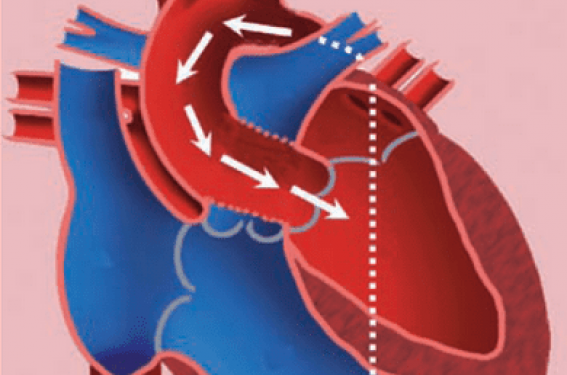 Chirurgie de la valve tricuspide  Unité de cardiologie et de chirurgie  cardiaque Jacques Cartier