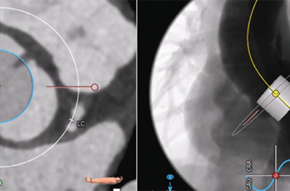 Valve aortique - C.I.I.C - Centre Interventionnelle et Imagerie Médicale