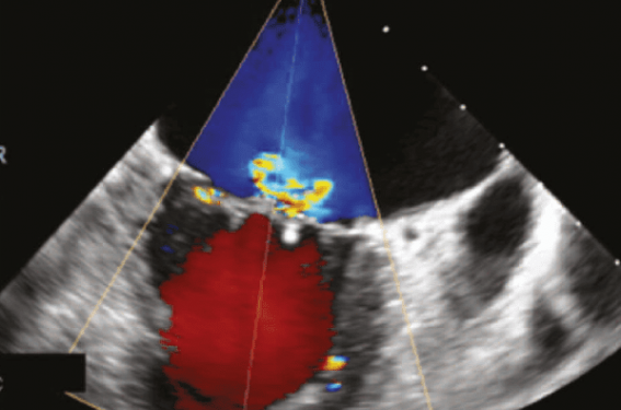 Cardiovalves 2019 : l'actualité dans l'insuffisance mitrale ...