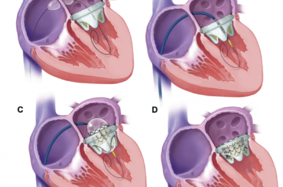 Plastie de la valve mitrale - Cardiologie et sport