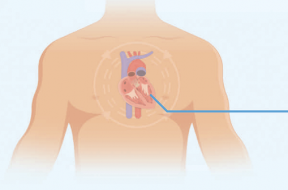 Remplacement de la valve aortique par cathéter (TAVI) - Centre de  Cardiologie Interventionnelle Belledonne