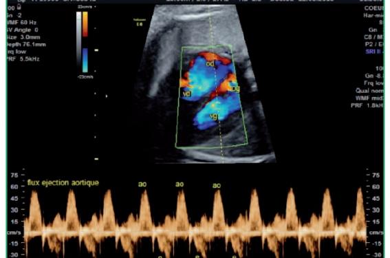 Doppler fœtal : ce qu'il faut savoir sur cet examen de la grossesse : Femme  Actuelle Le MAG