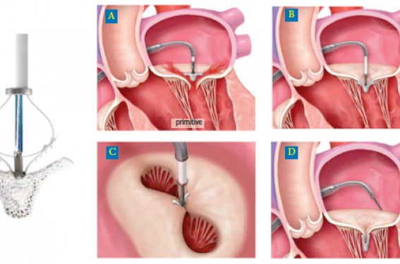 Chirurgie de la valve tricuspide  Unité de cardiologie et de chirurgie  cardiaque Jacques Cartier